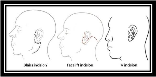 Incisions-for-Parotid-Surgery